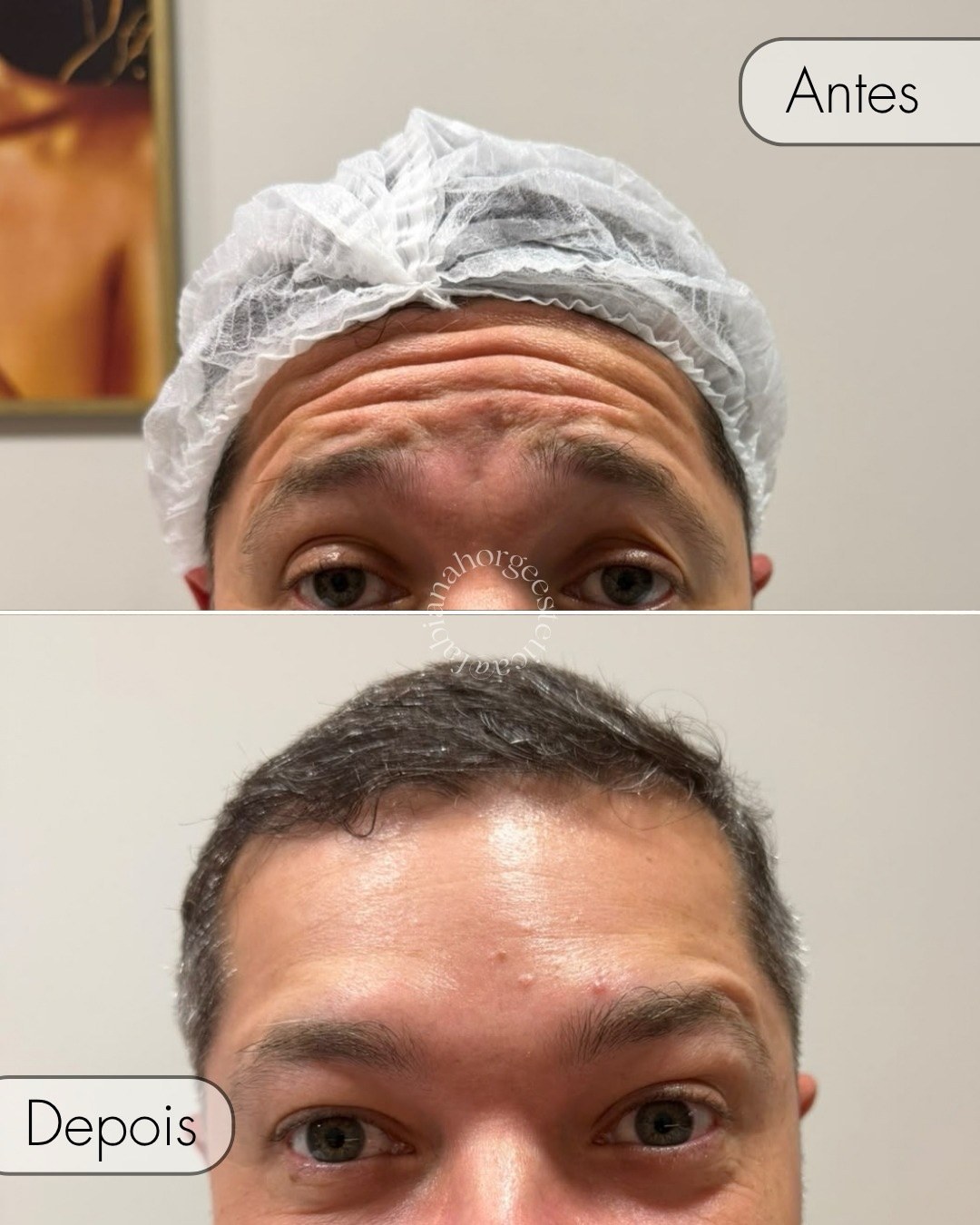 Antes e depois de toxina botulínica na testa