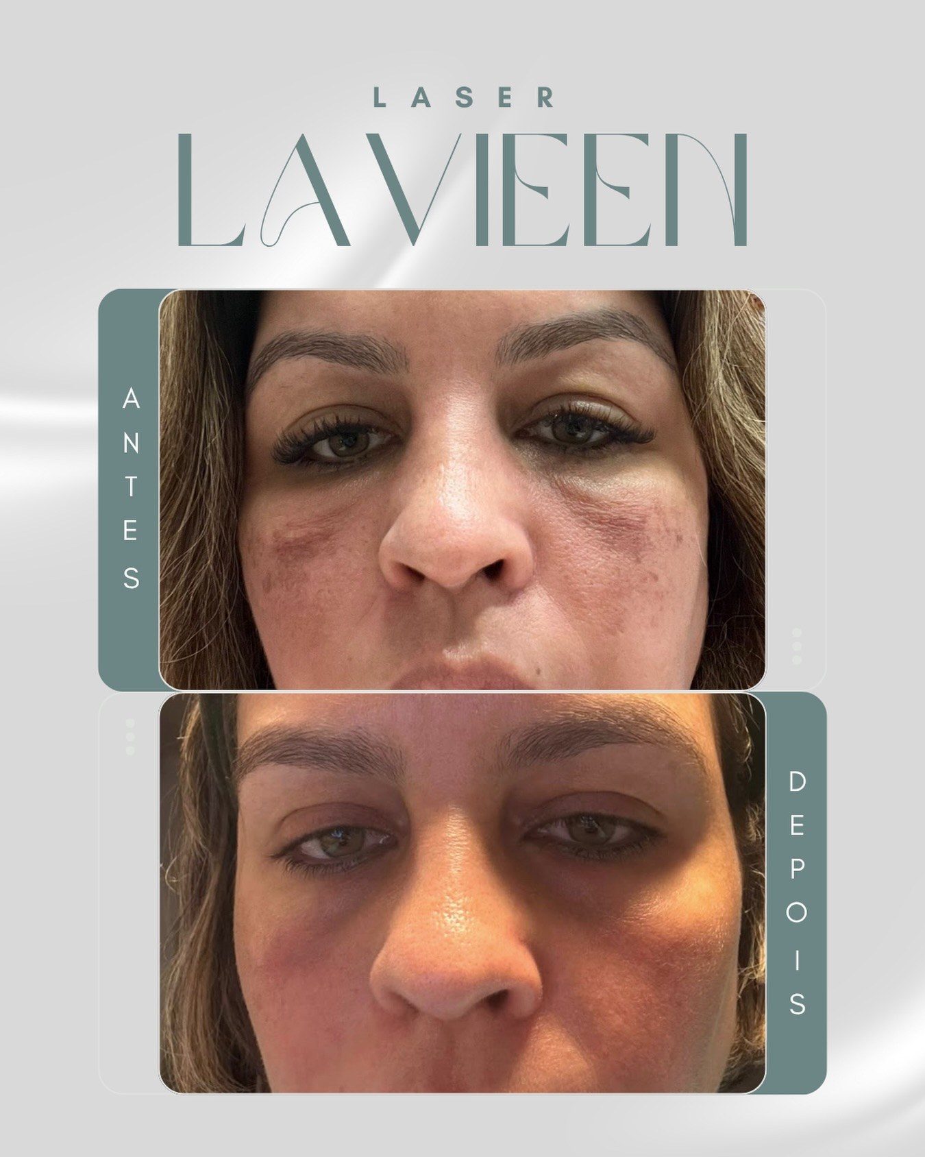 Antes e depois de laser Lavieen