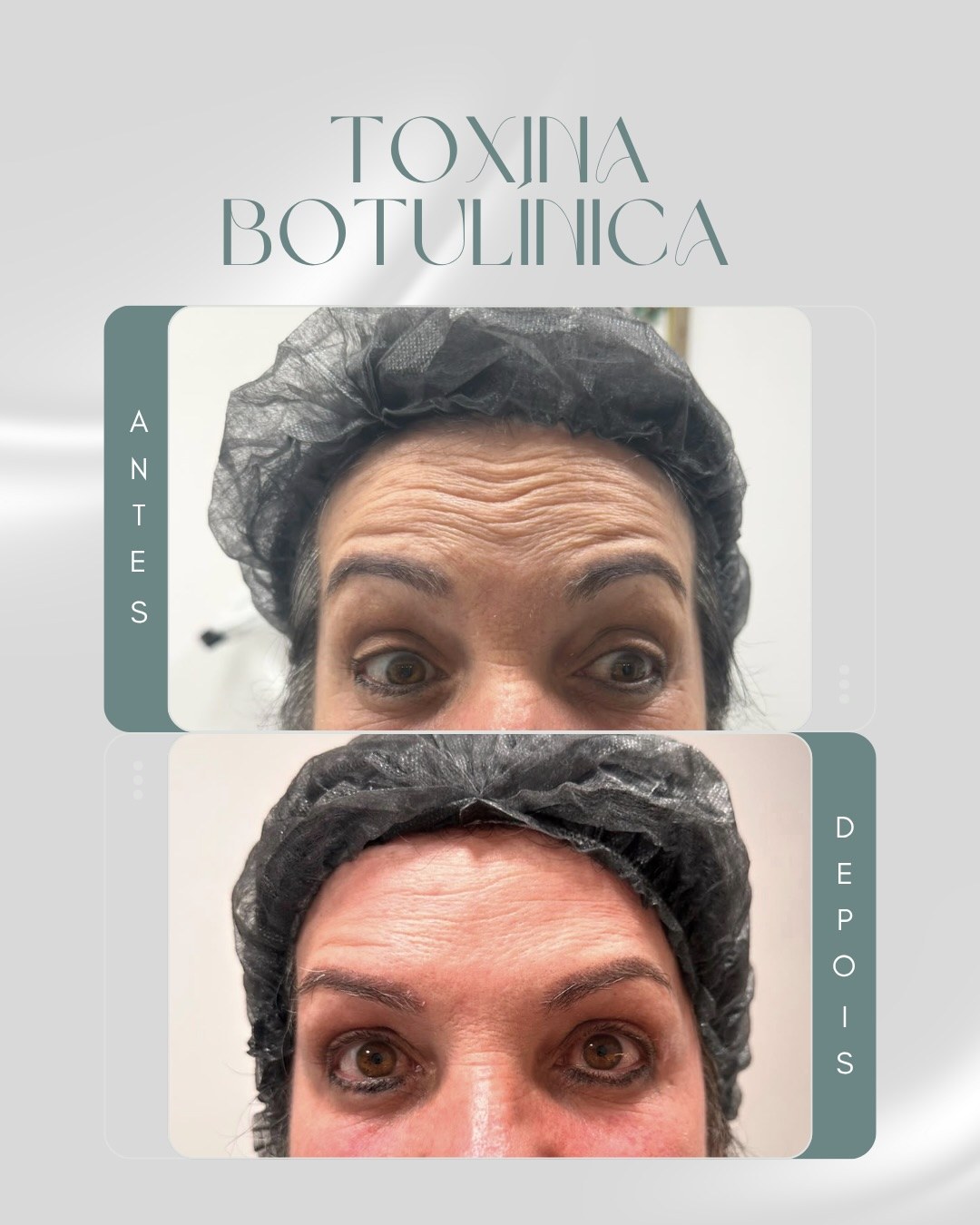 Antes e depois de toxina botulínica