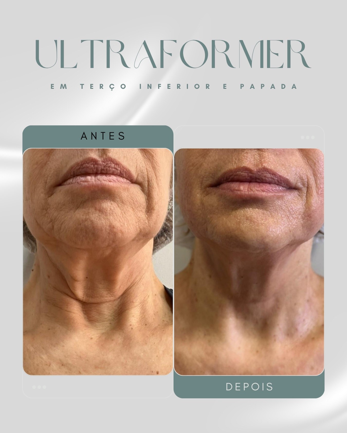 Antes e depois de Ultraformer no terço inferior e papada